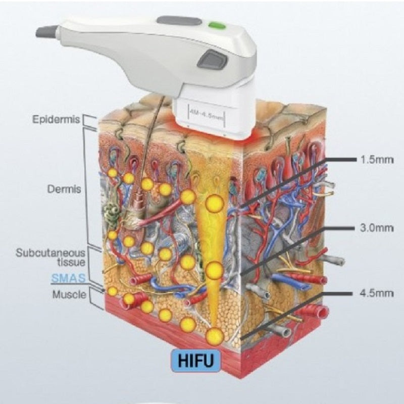 HIFU Facial 7D - Ultrasonidos Focalizados