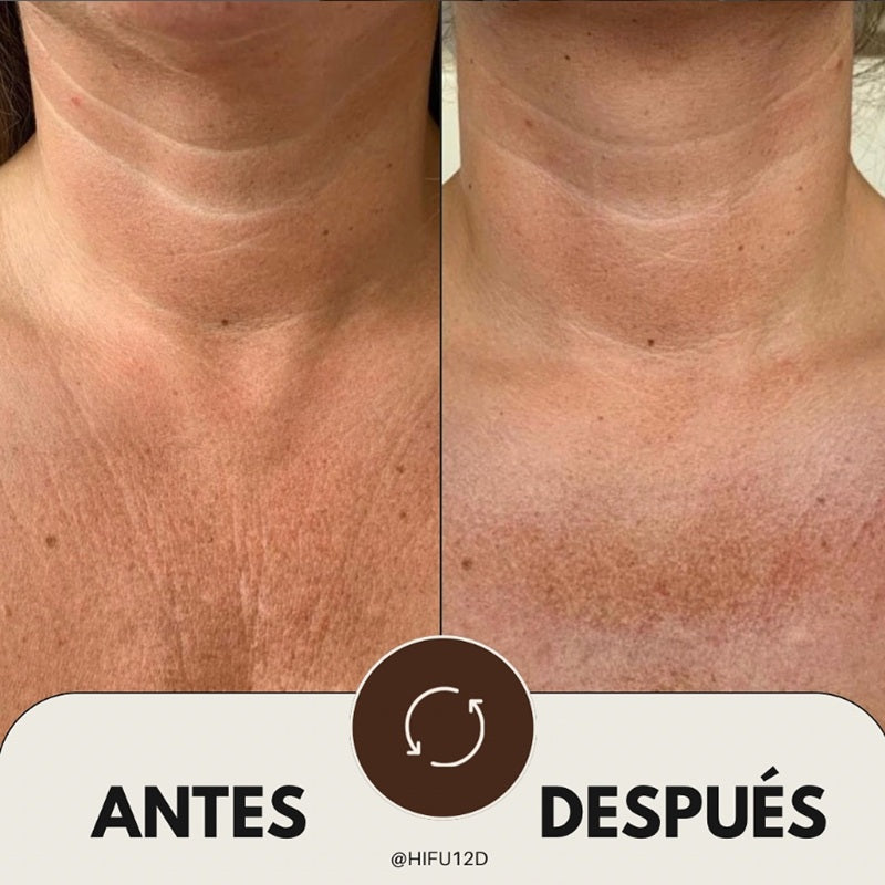 HIFU Corporal 7D | Ultrasonidos Focalizados