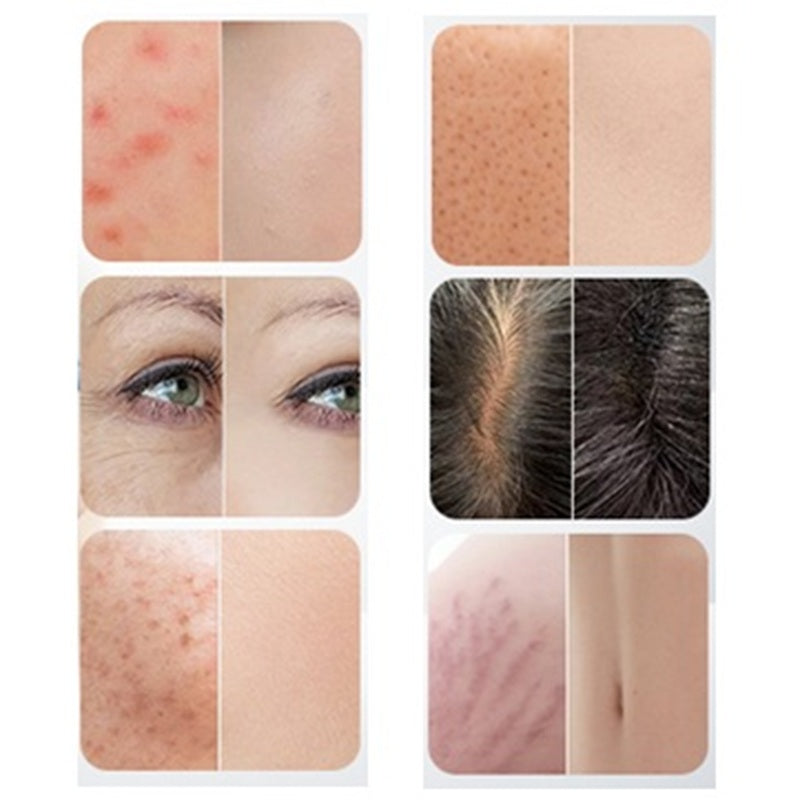 Hidra Dermapen facial EMS + Peeling