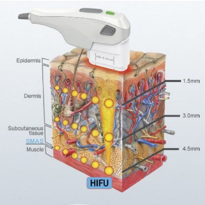 HIFU Facial 7D - Ultrasonidos Focalizados