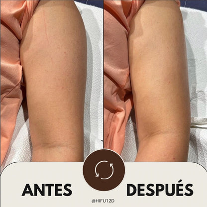 Vacuum Sculpt Pro - Pack Remodelación Corporal con EVO 3D + Ondas