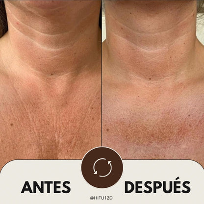 HIFU Corporal 7D | Ultrasonidos Focalizados