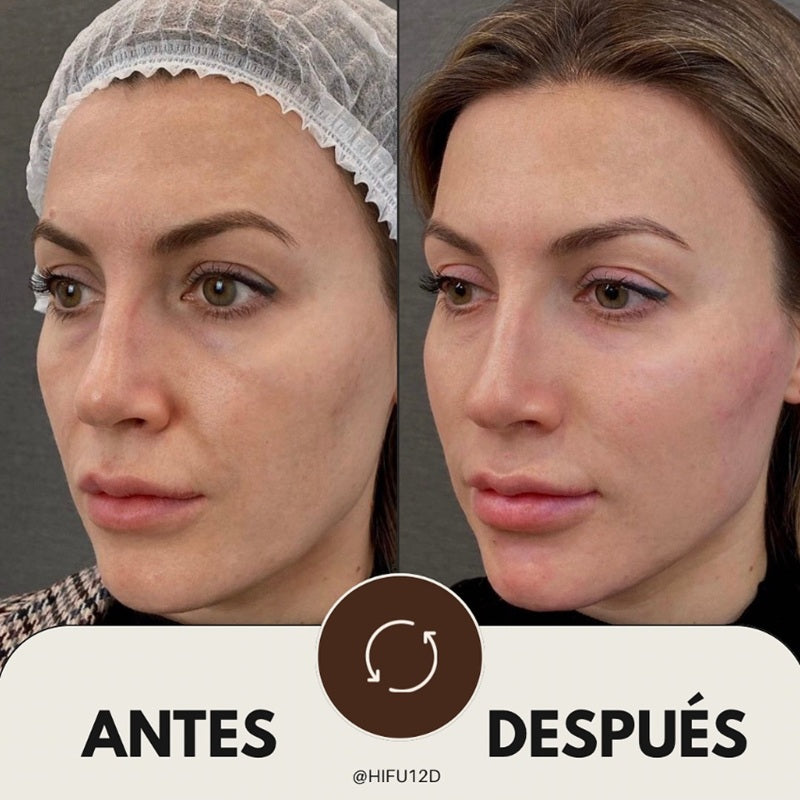 HIFU Facial 7D - Ultrasonidos Focalizados